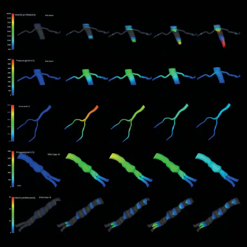 First personalized medical simulations of blood flow