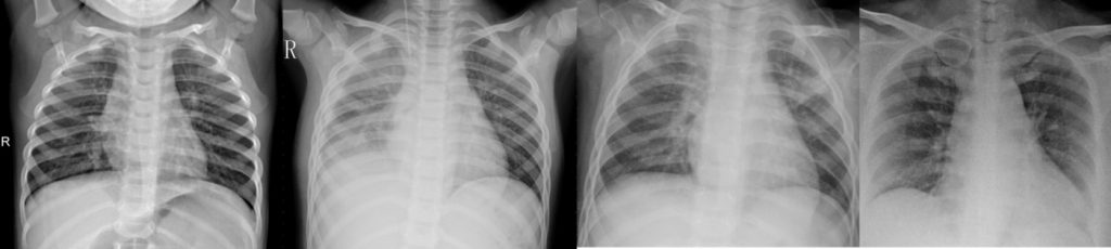 Classificazione delle radiografie polmonari con l'intelligenza artificiale: progetto DIMASDIA-COVID19